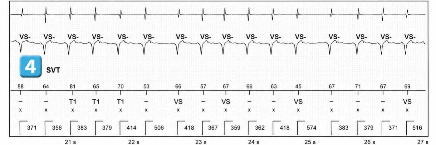 Abbott ICD electrogram, segment 4 of 5 — Simple chamber discrimination and discriminant association
