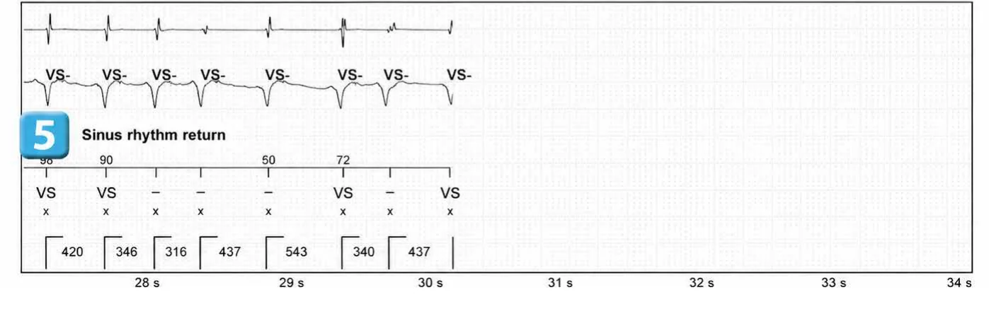 Abbott ICD electrogram, segment 5 of 5 — Simple chamber discrimination and discriminant association