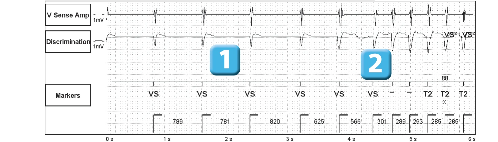 Abbott ICD electrogram, segment 1 of 3 — Single-chamber discrimination and optimization of the criterion based on morphology