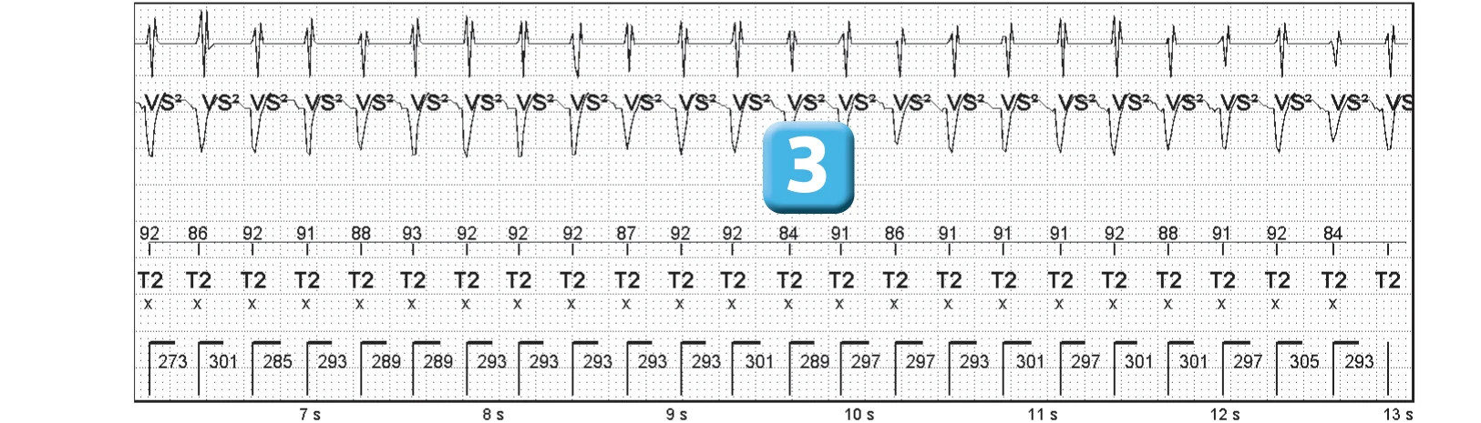 Abbott ICD electrogram, segment 2 of 3 — Single-chamber discrimination and optimization of the criterion based on morphology