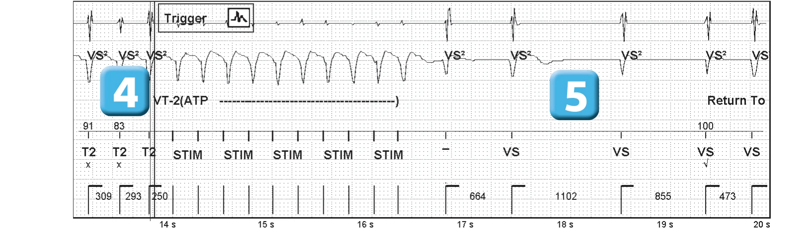 Abbott ICD electrogram, segment 3 of 3 — Single-chamber discrimination and optimization of the criterion based on morphology
