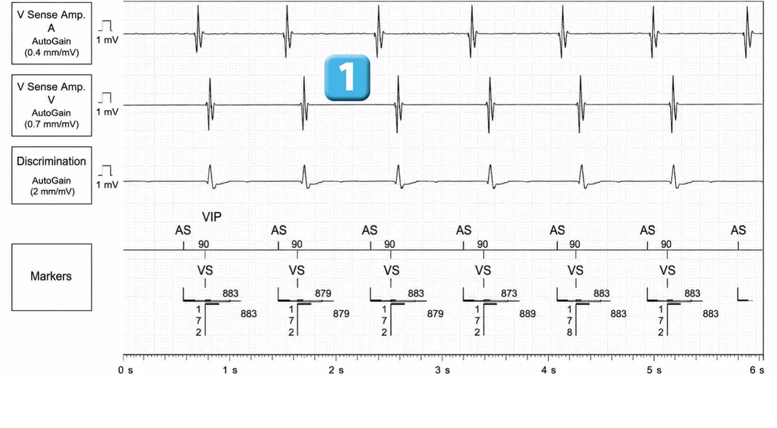 Abbott ICD electrogram, segment 1 of 5 — Discrimination between double chamber and branch V > A