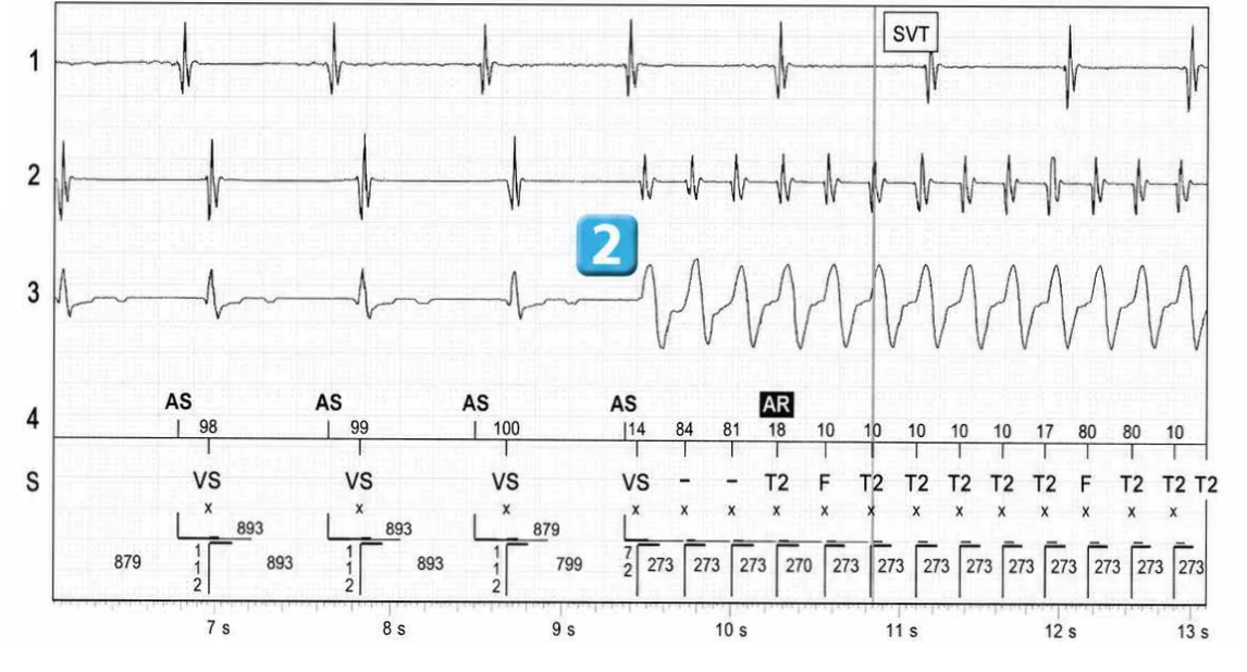 Abbott ICD electrogram, segment 2 of 5 — Discrimination between double chamber and branch V > A