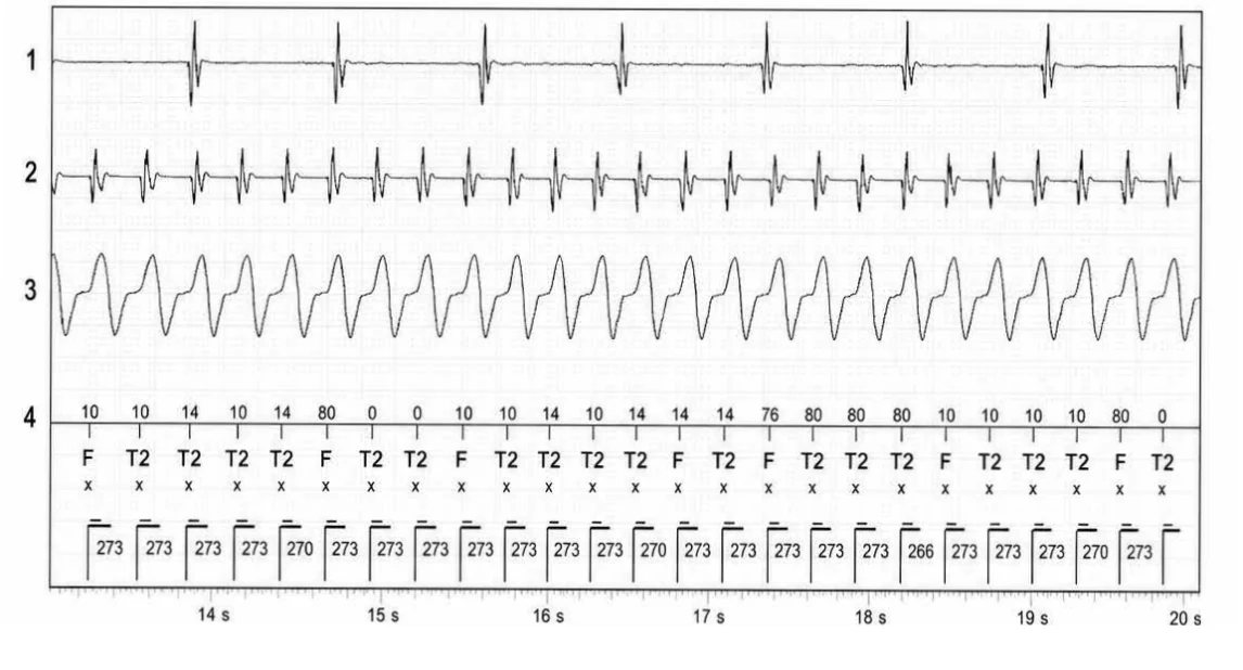 Abbott ICD electrogram, segment 3 of 5 — Discrimination between double chamber and branch V > A