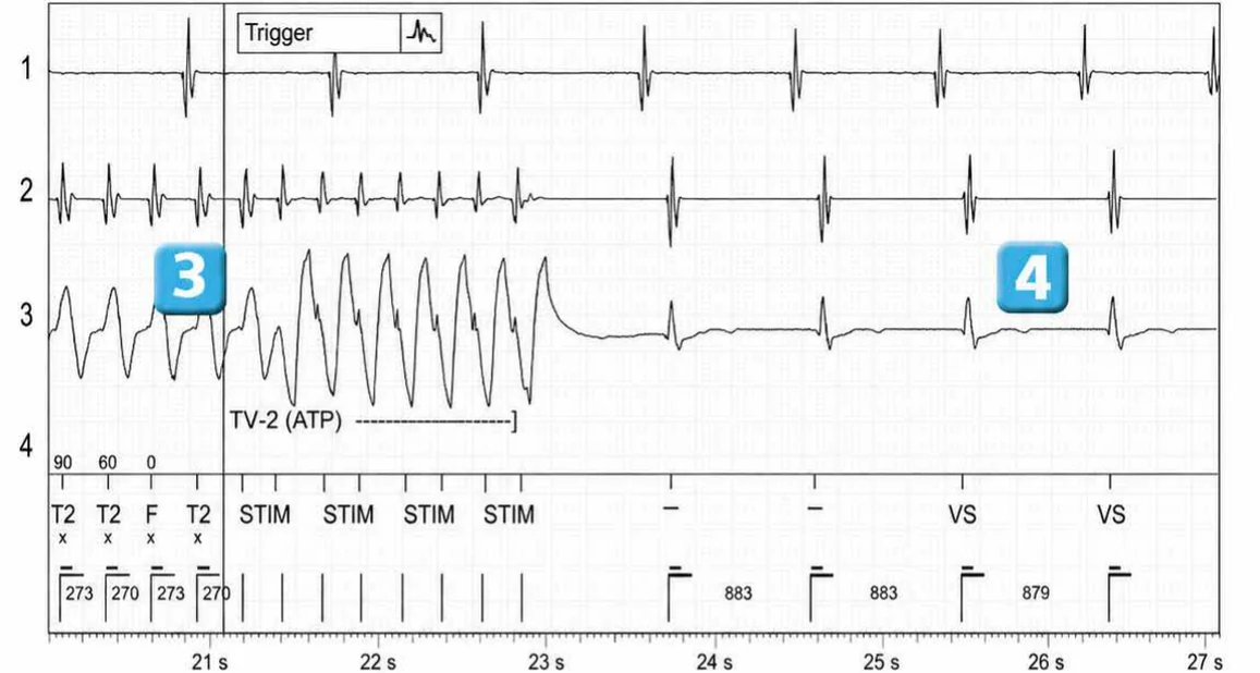 Abbott ICD electrogram, segment 4 of 5 — Discrimination between double chamber and branch V > A