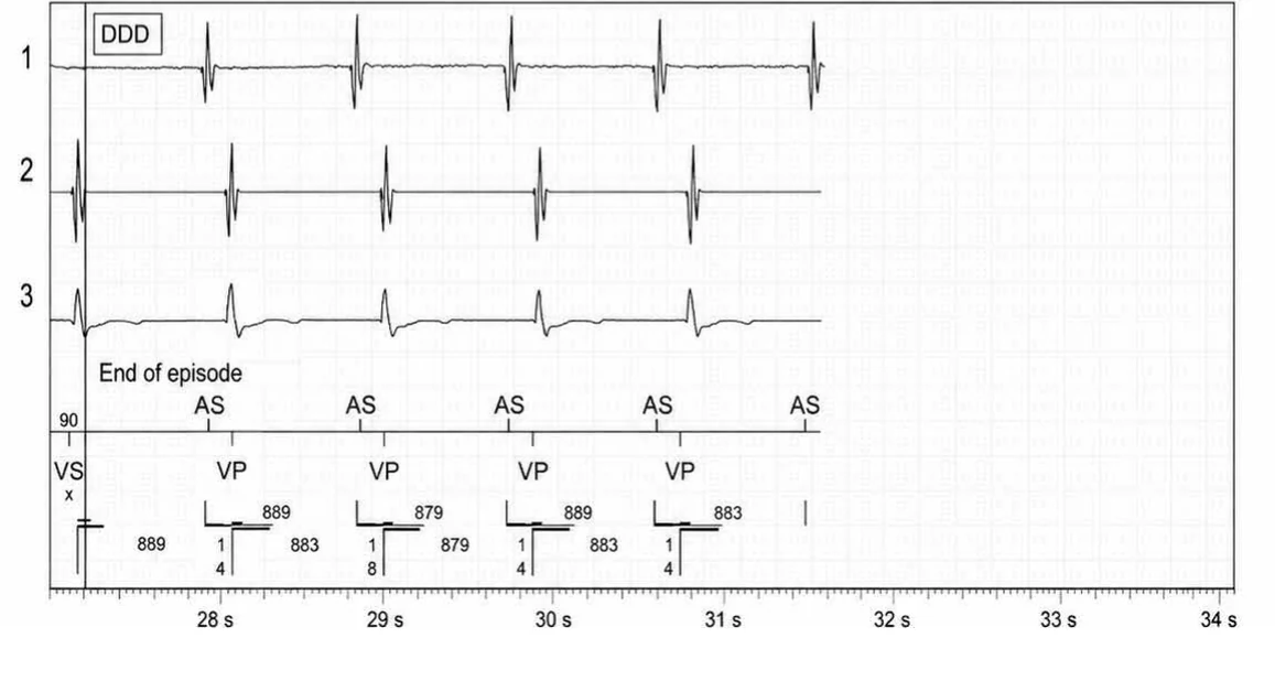 Abbott ICD electrogram, segment 5 of 5 — Discrimination between double chamber and branch V > A