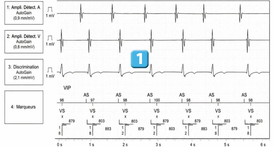 Abbott ICD electrogram, segment 1 of 4 — Double chamber and branch discrimination V = A