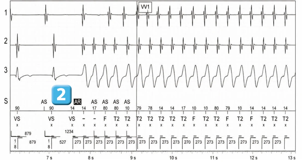 Abbott ICD electrogram, segment 2 of 4 — Double chamber and branch discrimination V = A