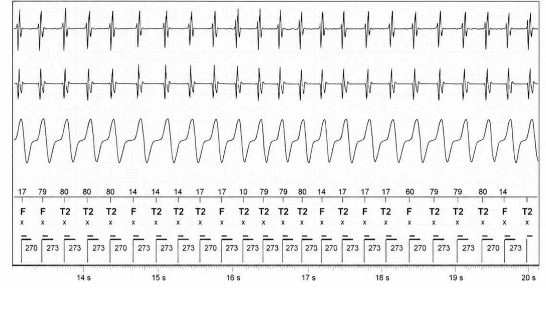 Abbott ICD electrogram, segment 3 of 4 — Double chamber and branch discrimination V = A