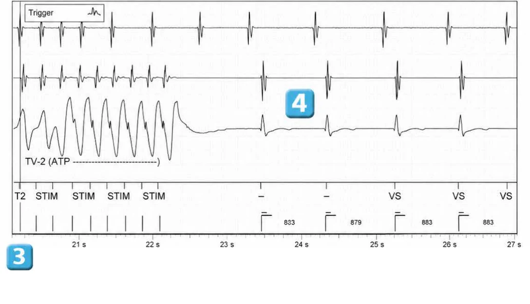 Abbott ICD electrogram, segment 4 of 4 — Double chamber and branch discrimination V = A