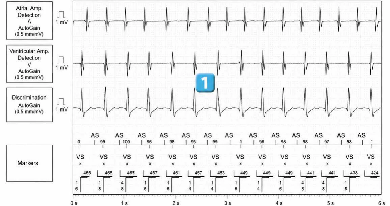 Abbott ICD electrogram, segment 1 of 14 — Double chamber and branch discrimination V = A