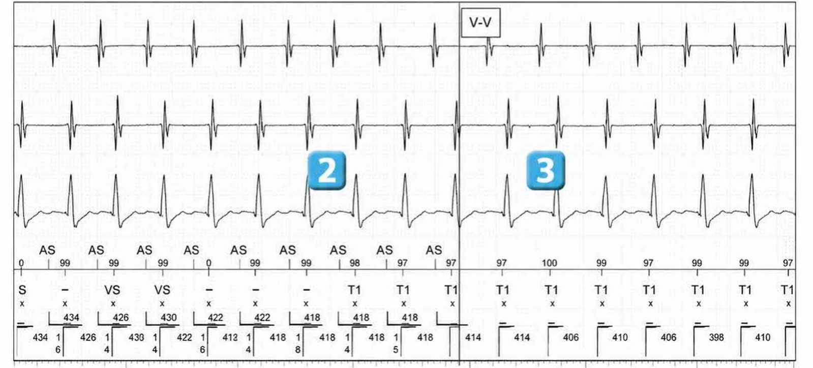 Abbott ICD electrogram, segment 2 of 14 — Double chamber and branch discrimination V = A