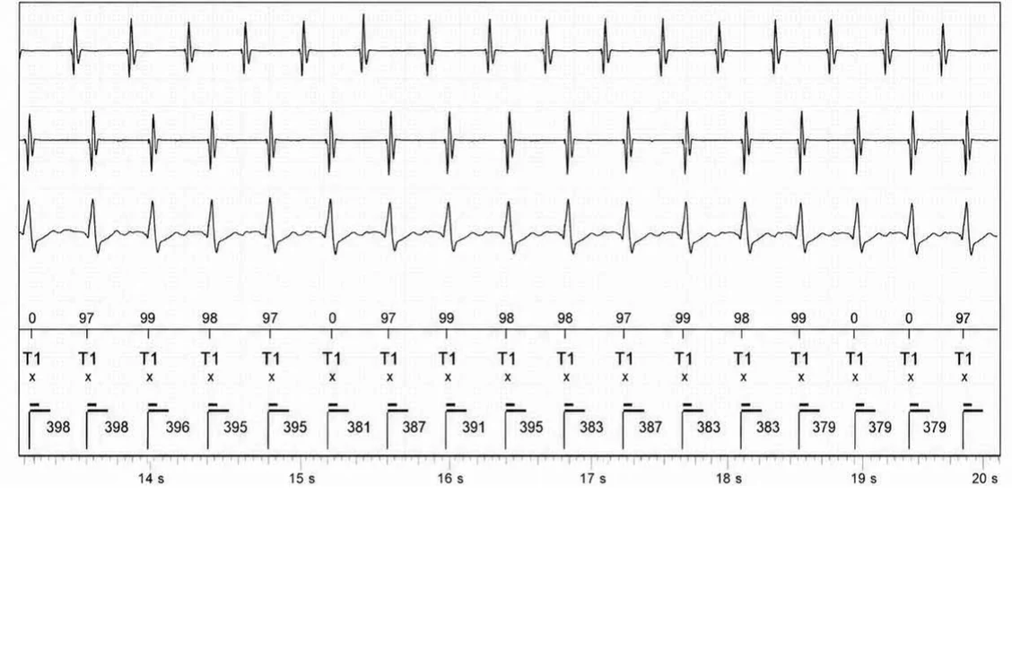 Abbott ICD electrogram, segment 3 of 14 — Double chamber and branch discrimination V = A