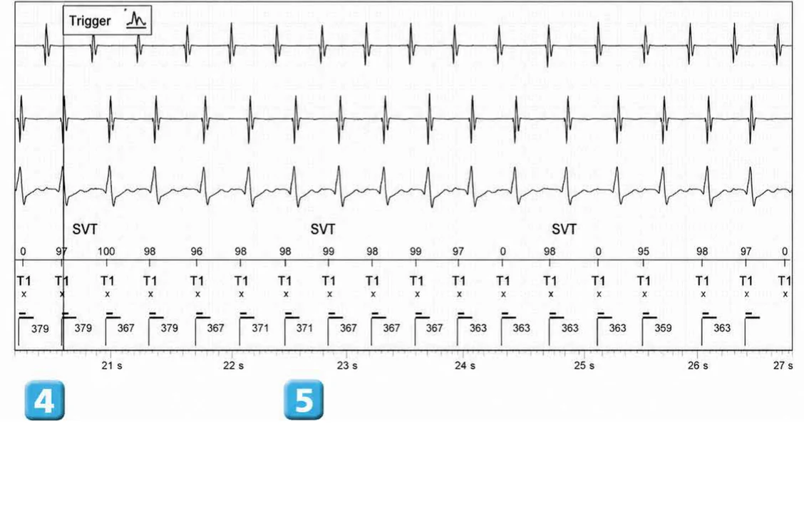 Abbott ICD electrogram, segment 4 of 14 — Double chamber and branch discrimination V = A