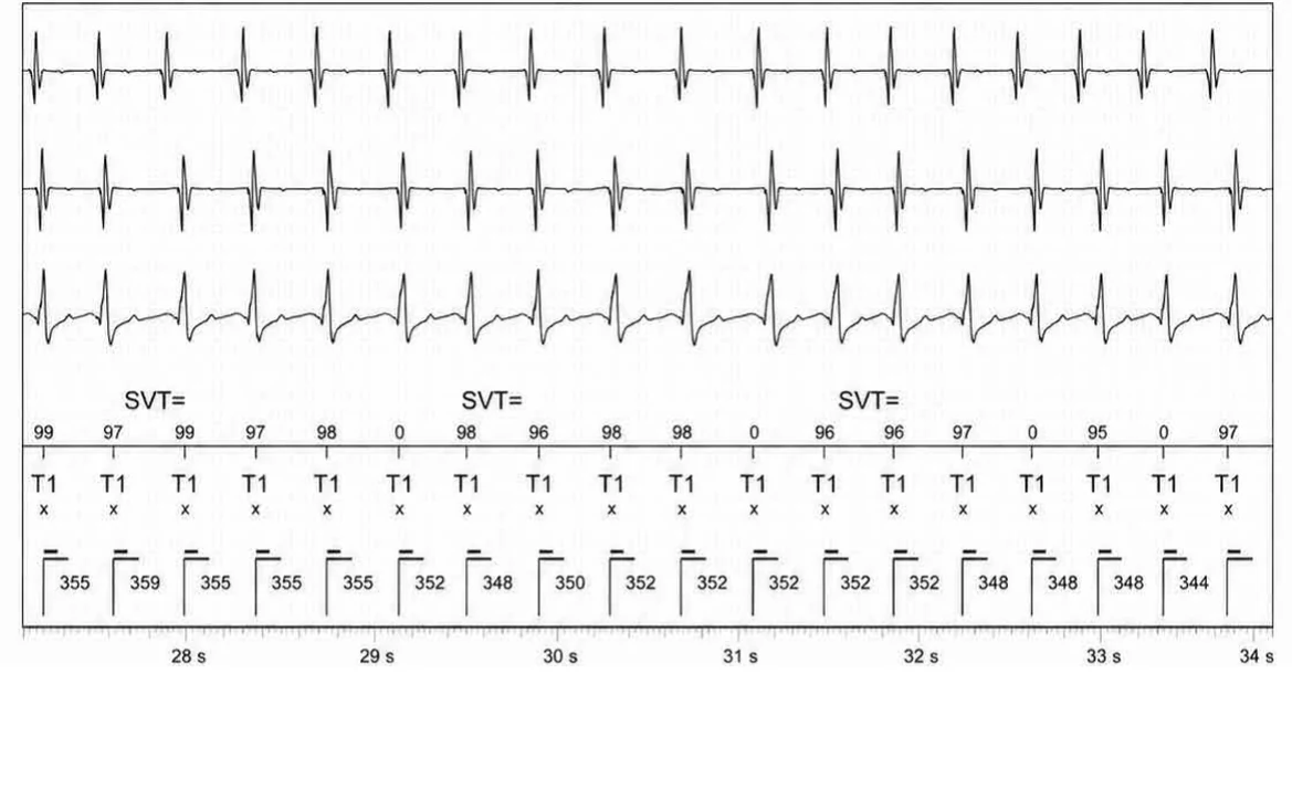Abbott ICD electrogram, segment 5 of 14 — Double chamber and branch discrimination V = A