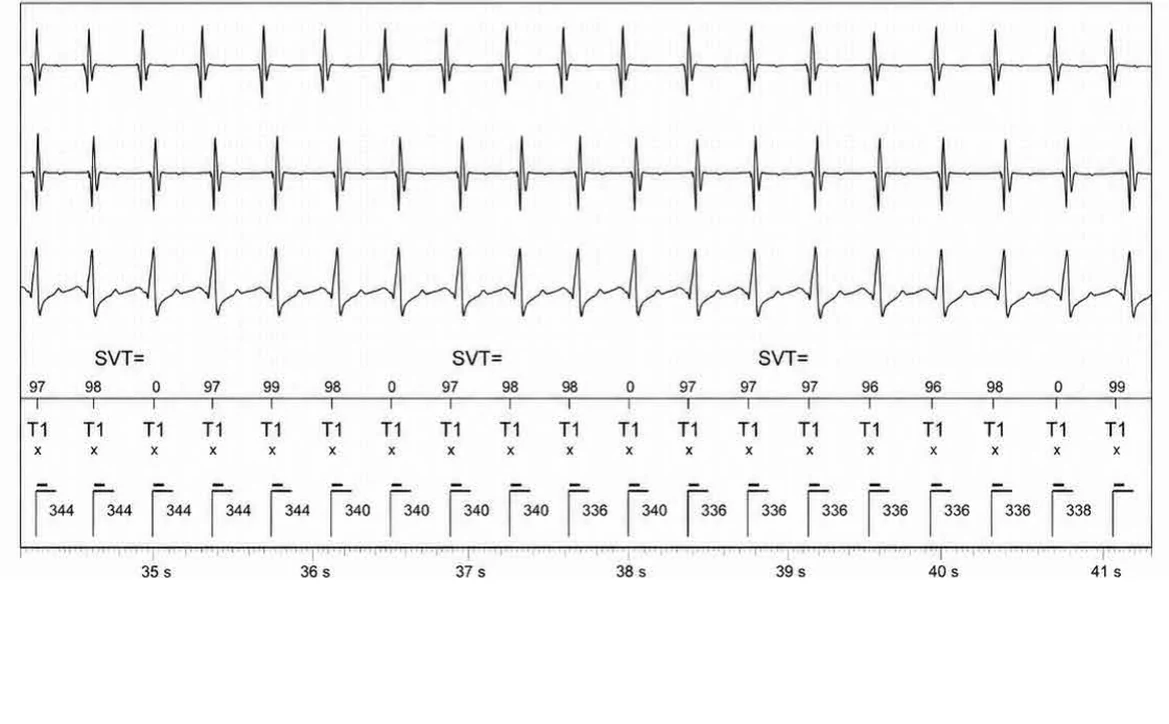 Abbott ICD electrogram, segment 6 of 14 — Double chamber and branch discrimination V = A
