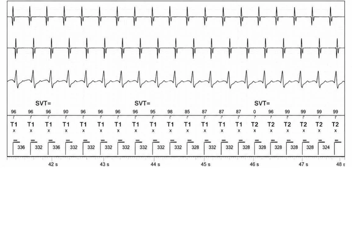 Abbott ICD electrogram, segment 7 of 14 — Double chamber and branch discrimination V = A