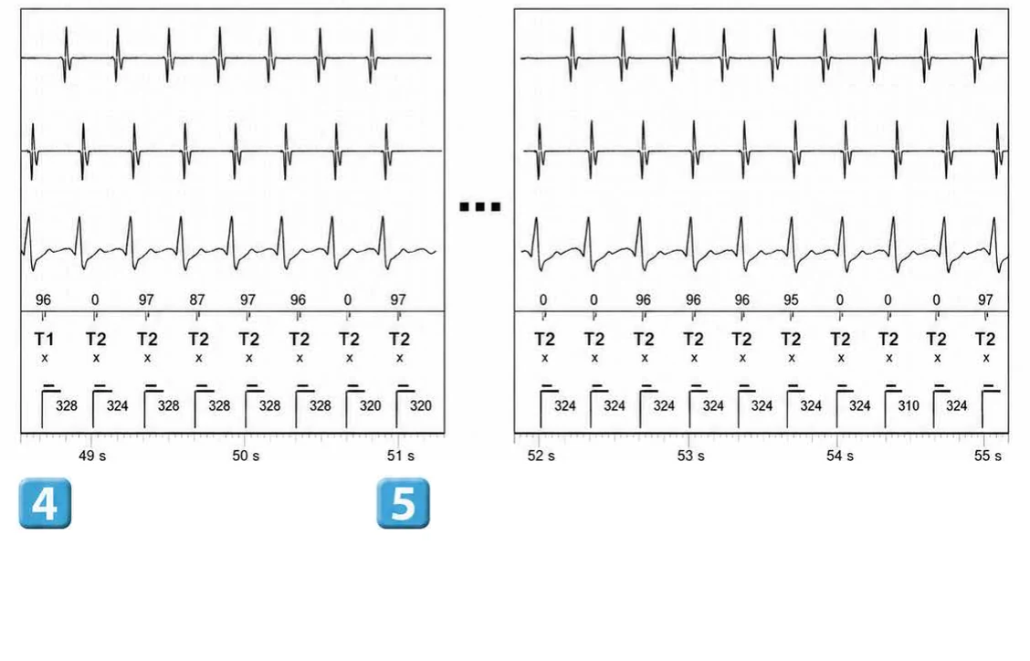 Abbott ICD electrogram, segment 8 of 14 — Double chamber and branch discrimination V = A