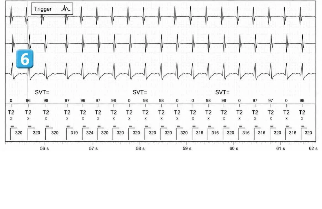 Abbott ICD electrogram, segment 9 of 14 — Double chamber and branch discrimination V = A