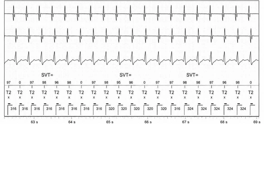 Abbott ICD electrogram, segment 10 of 14 — Double chamber and branch discrimination V = A