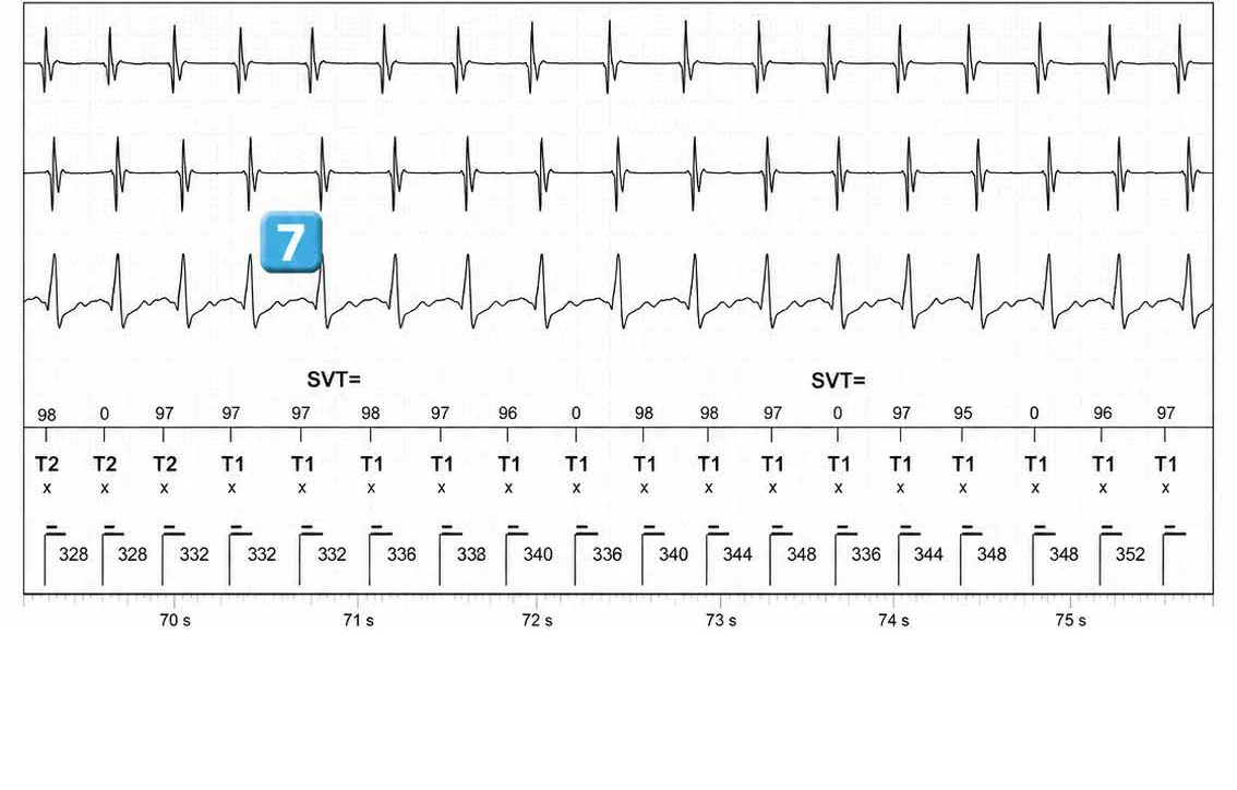 Abbott ICD electrogram, segment 11 of 14 — Double chamber and branch discrimination V = A