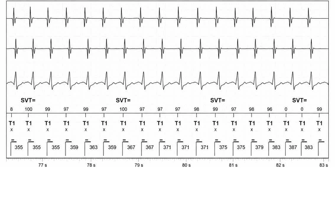 Abbott ICD electrogram, segment 12 of 14 — Double chamber and branch discrimination V = A