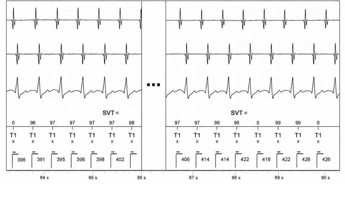 Abbott ICD electrogram, segment 13 of 14 — Double chamber and branch discrimination V = A