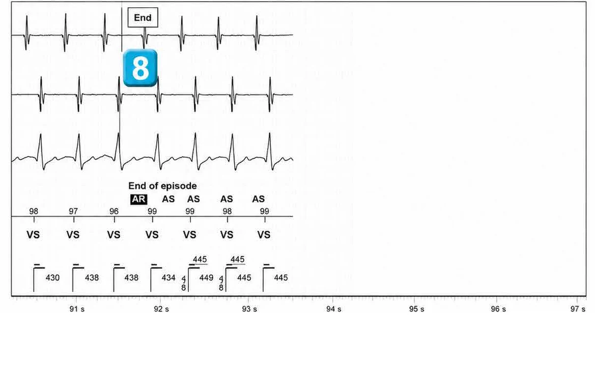 Abbott ICD electrogram, segment 14 of 14 — Double chamber and branch discrimination V = A