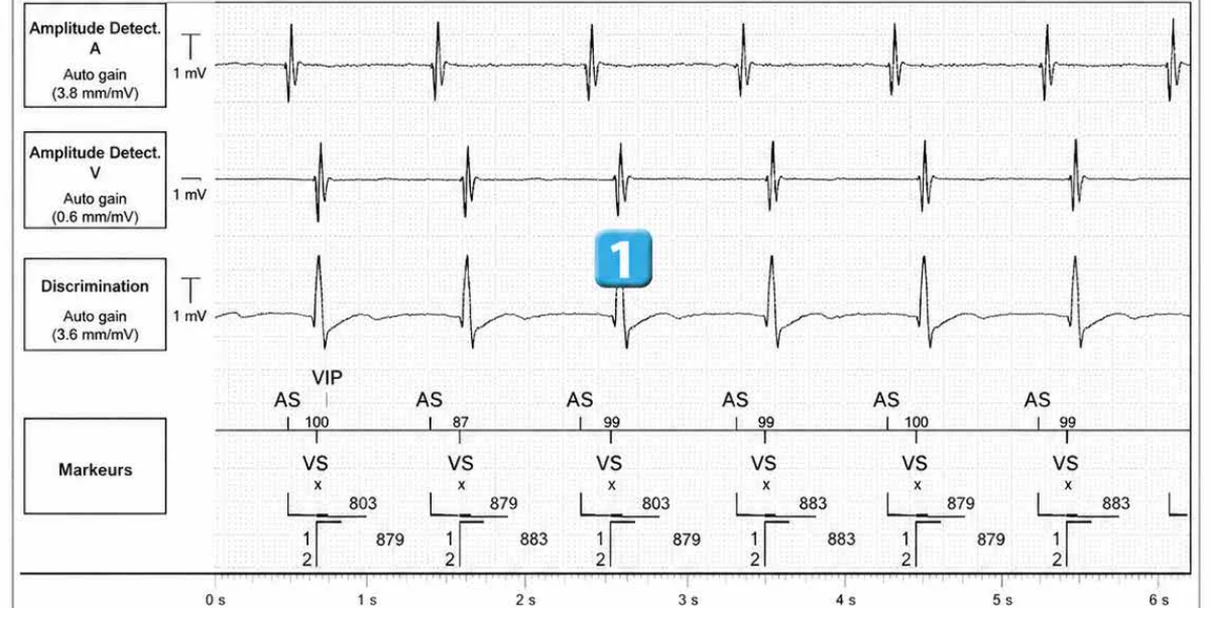 Abbott ICD electrogram, segment 1 of 5 — Double chamber and branch discrimination V = A