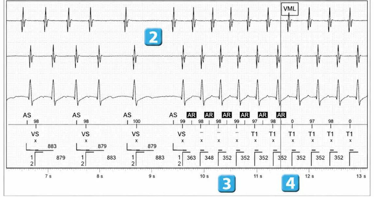 Abbott ICD electrogram, segment 2 of 5 — Double chamber and branch discrimination V = A