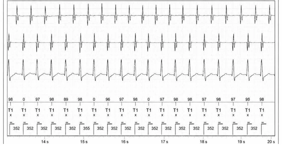 Abbott ICD electrogram, segment 3 of 5 — Double chamber and branch discrimination V = A