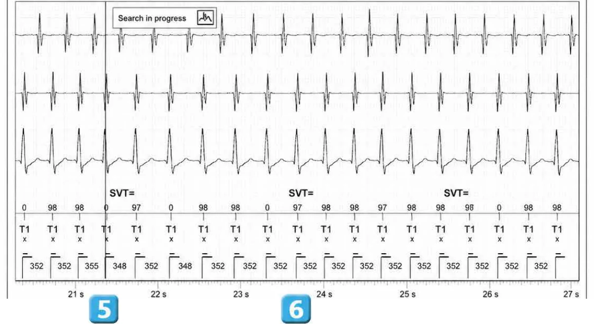 Abbott ICD electrogram, segment 4 of 5 — Double chamber and branch discrimination V = A