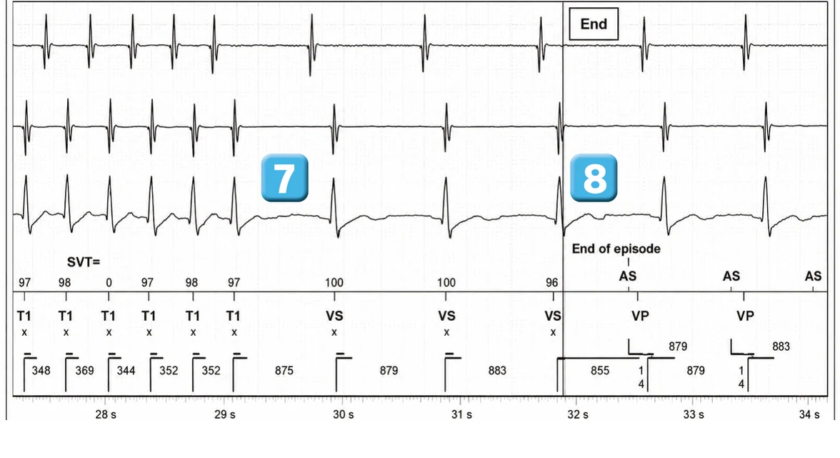 Abbott ICD electrogram, segment 5 of 5 — Double chamber and branch discrimination V = A