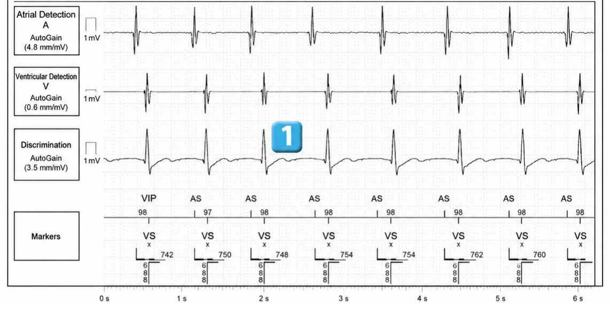 Abbott ICD electrogram, segment 1 of 5 — Dual chamber and V< A branch discrimination