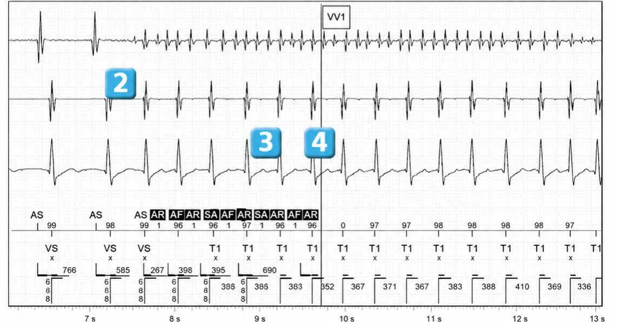 Abbott ICD electrogram, segment 2 of 5 — Dual chamber and V< A branch discrimination