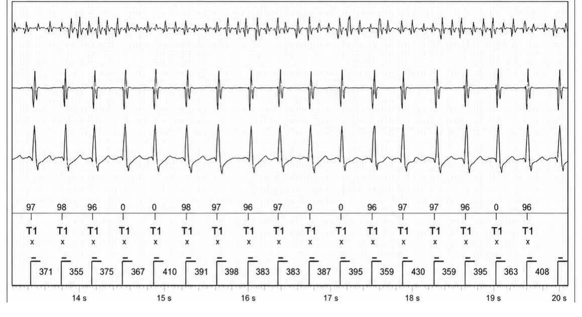 Abbott ICD electrogram, segment 3 of 5 — Dual chamber and V< A branch discrimination