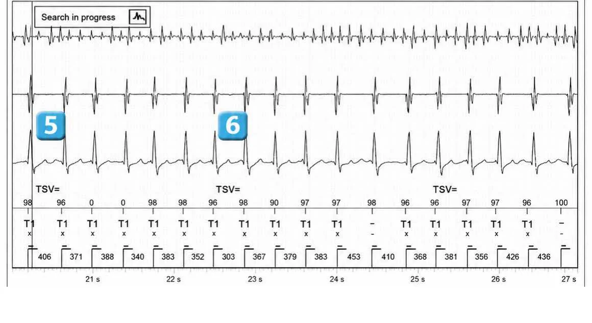 Abbott ICD electrogram, segment 4 of 5 — Dual chamber and V< A branch discrimination