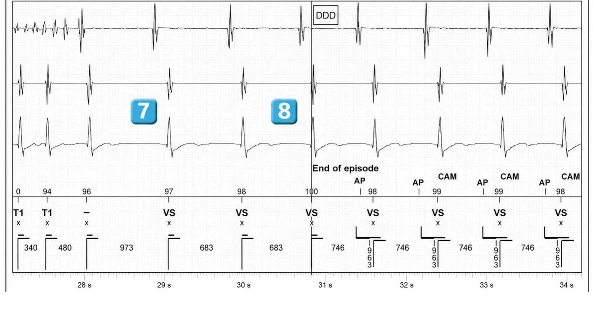 Abbott ICD electrogram, segment 5 of 5 — Dual chamber and V< A branch discrimination