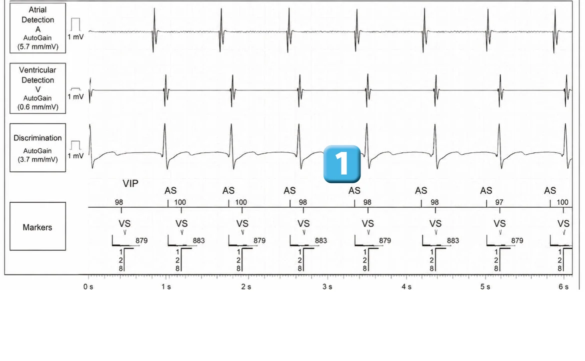 Abbott ICD electrogram, segment 1 of 5 — Dual chamber and V< A branch discrimination