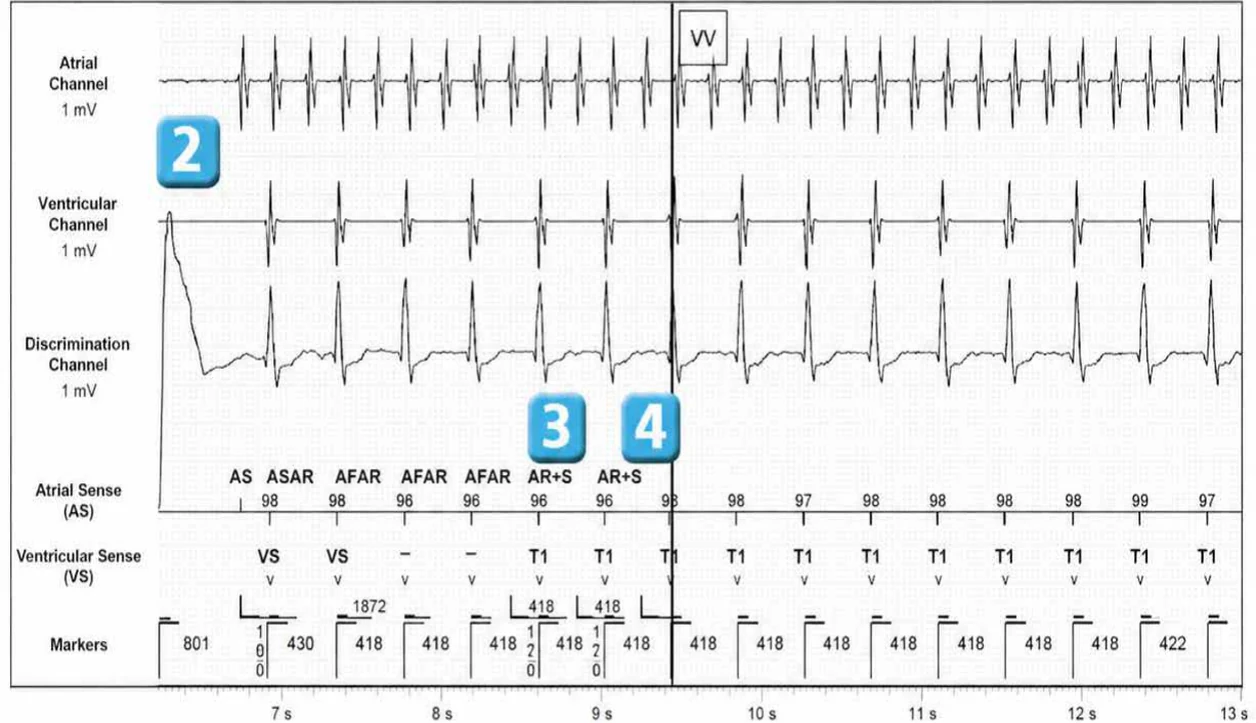Abbott ICD electrogram, segment 2 of 5 — Dual chamber and V< A branch discrimination