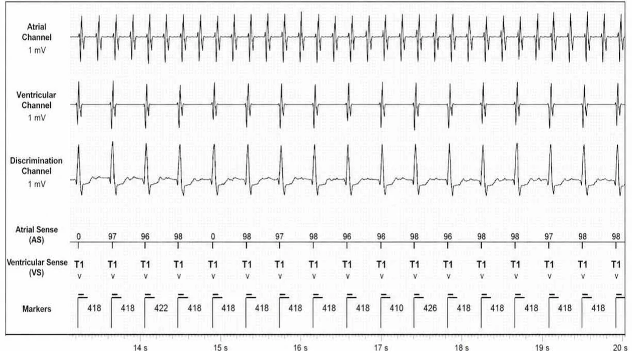 Abbott ICD electrogram, segment 3 of 5 — Dual chamber and V< A branch discrimination