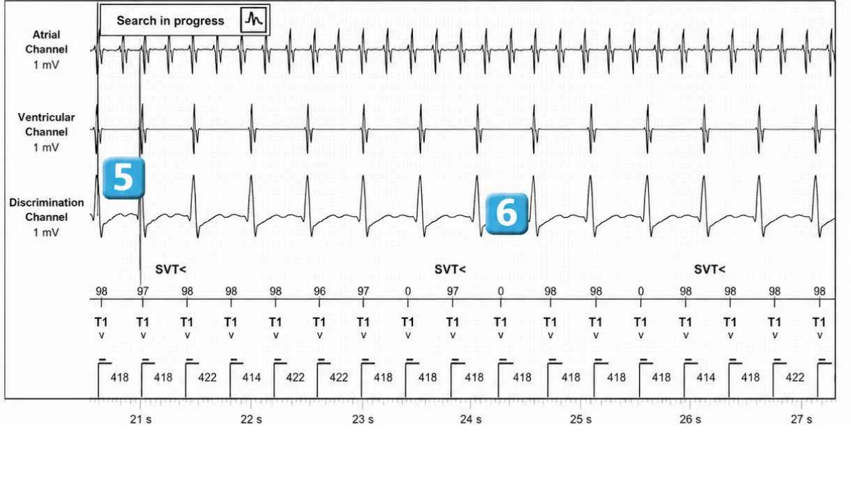 Abbott ICD electrogram, segment 4 of 5 — Dual chamber and V< A branch discrimination