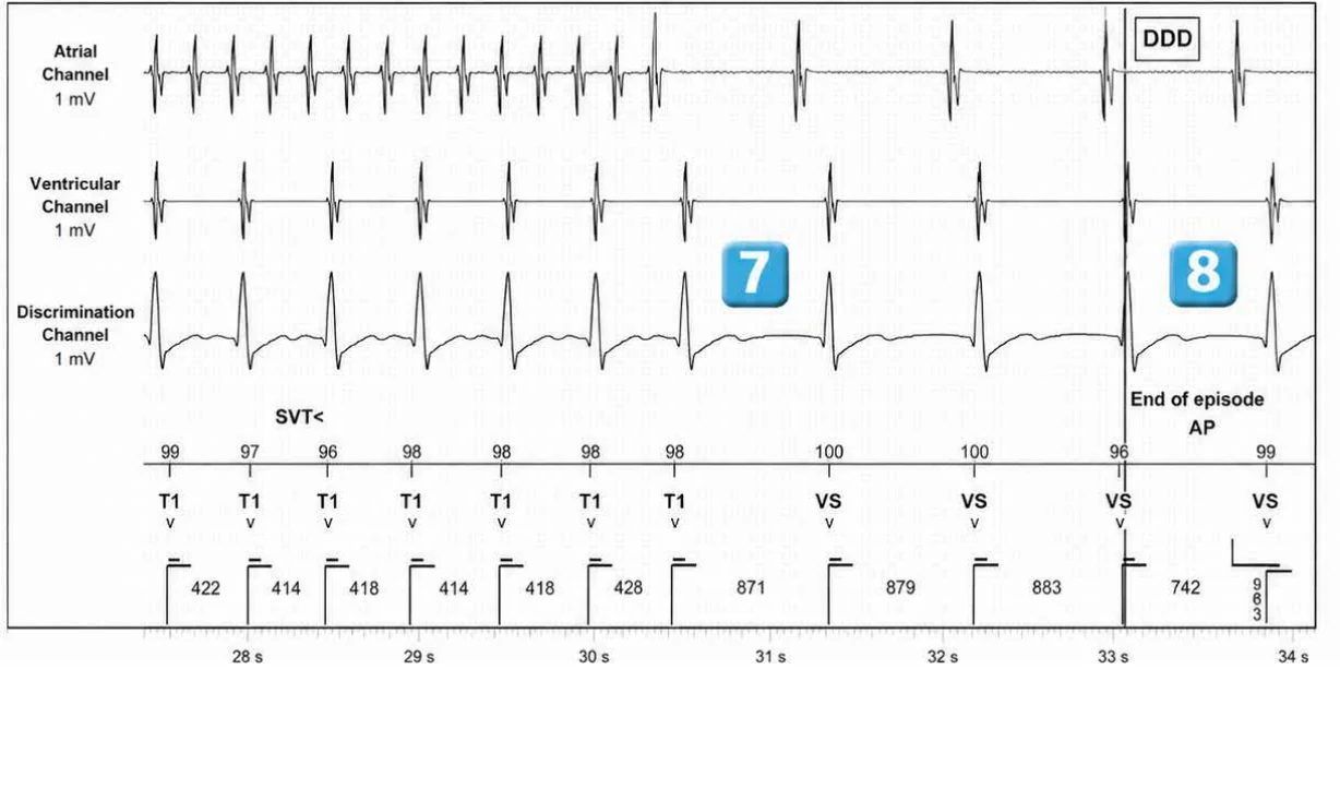 Abbott ICD electrogram, segment 5 of 5 — Dual chamber and V< A branch discrimination
