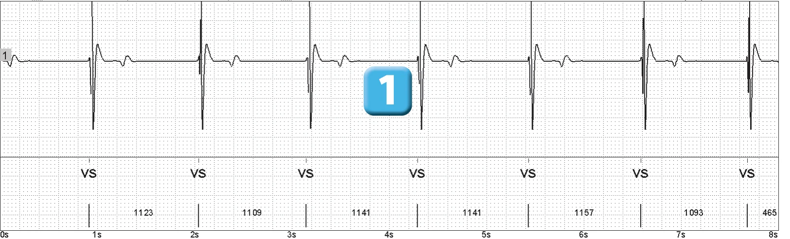 Abbott ICD electrogram, segment 1 of 3 — Lead breakage on an older model
