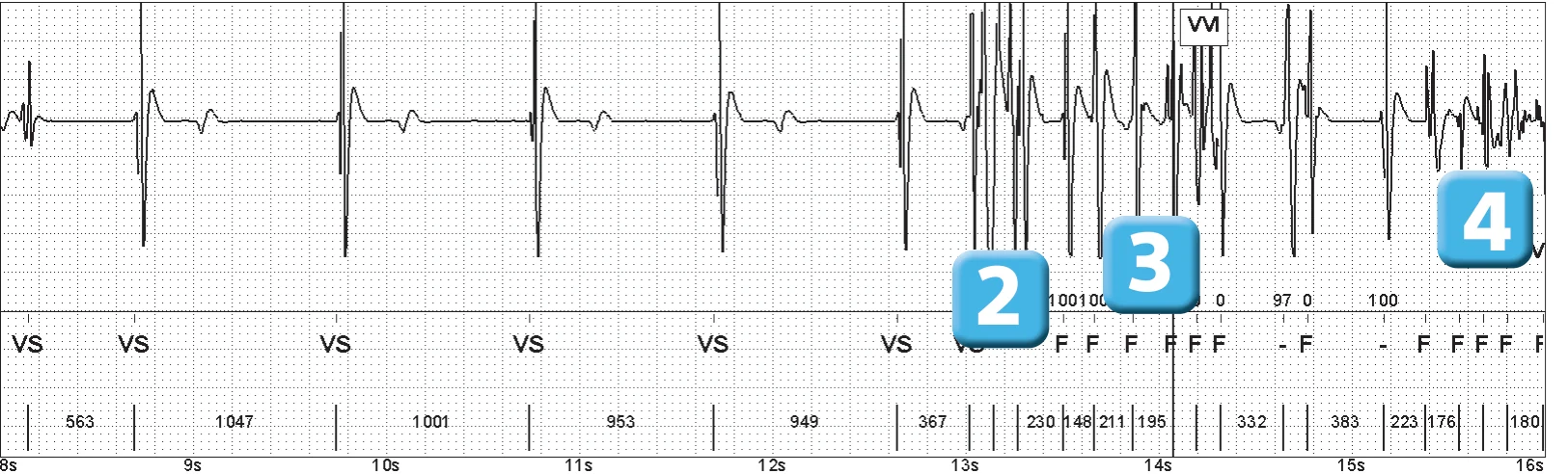 Abbott ICD electrogram, segment 2 of 3 — Lead breakage on an older model