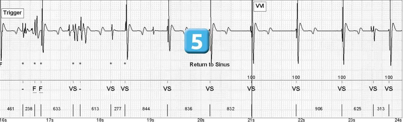 Abbott ICD electrogram, segment 3 of 3 — Lead breakage on an older model
