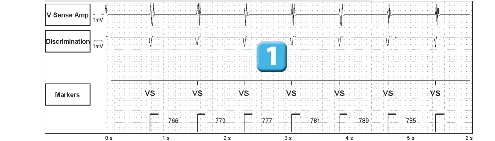Abbott ICD electrogram, segment 1 of 4 — Oversensing of a 50 Hz signal