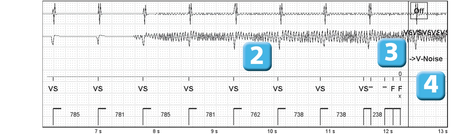 Abbott ICD electrogram, segment 2 of 4 — Oversensing of a 50 Hz signal