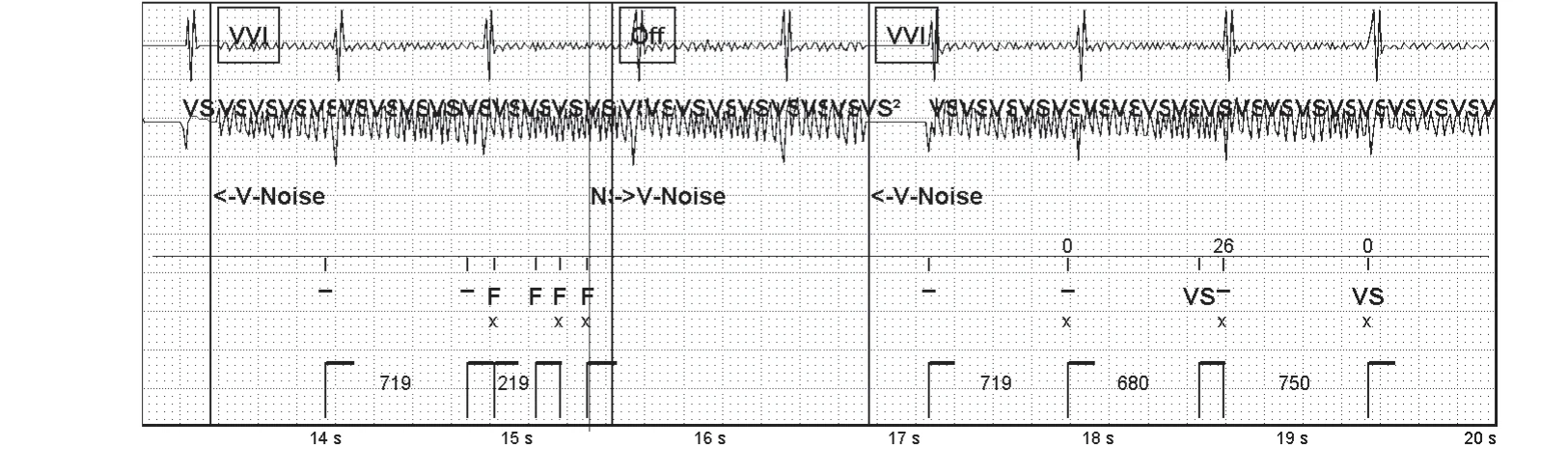 Abbott ICD electrogram, segment 3 of 4 — Oversensing of a 50 Hz signal