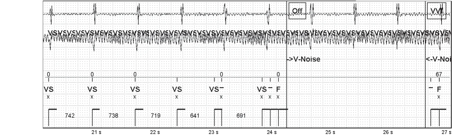 Abbott ICD electrogram, segment 4 of 4 — Oversensing of a 50 Hz signal